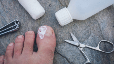 ingrown toenail removal